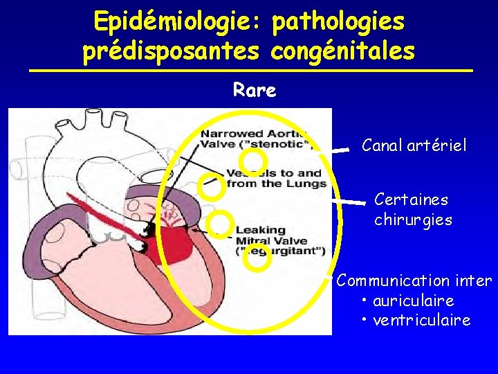 Epidémiologie: pathologies prédisposantes congénitales Rare Canal artériel Certaines chirurgies Communication inter • auriculaire •