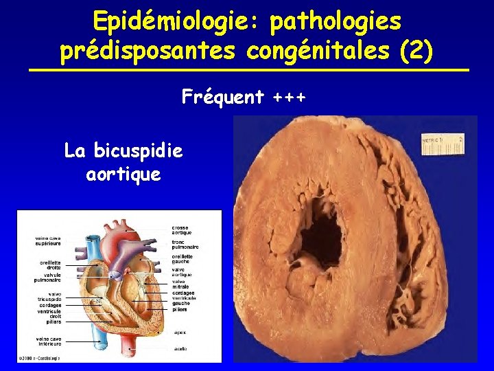 Epidémiologie: pathologies prédisposantes congénitales (2) Fréquent +++ La bicuspidie aortique 