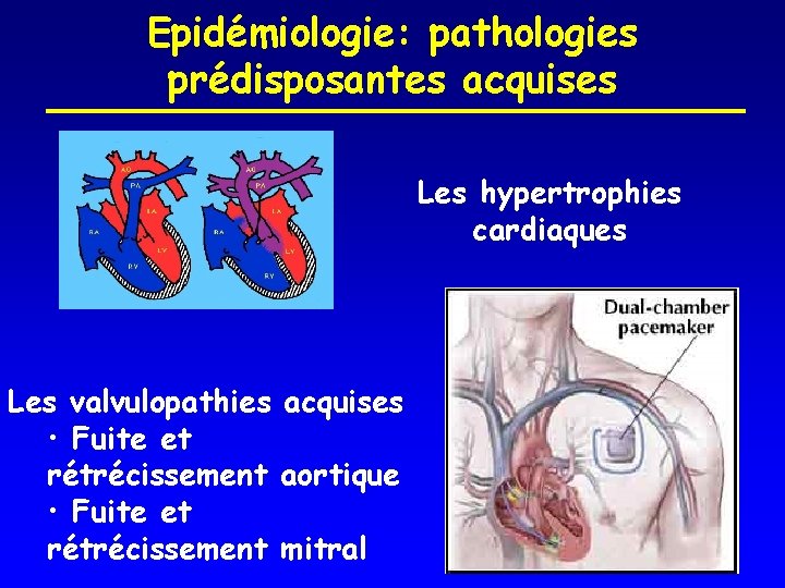 Epidémiologie: pathologies prédisposantes acquises Les hypertrophies cardiaques Les valvulopathies acquises • Fuite et rétrécissement