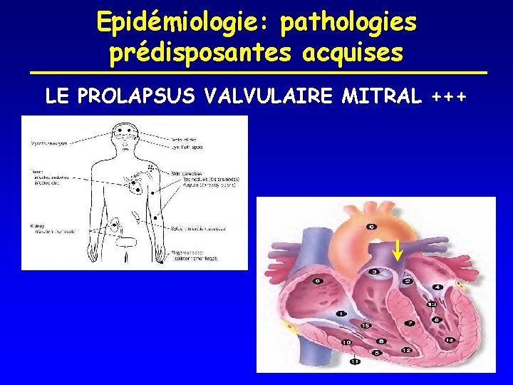 Epidémiologie: pathologies prédisposantes acquises LE PROLAPSUS VALVULAIRE MITRAL +++ 