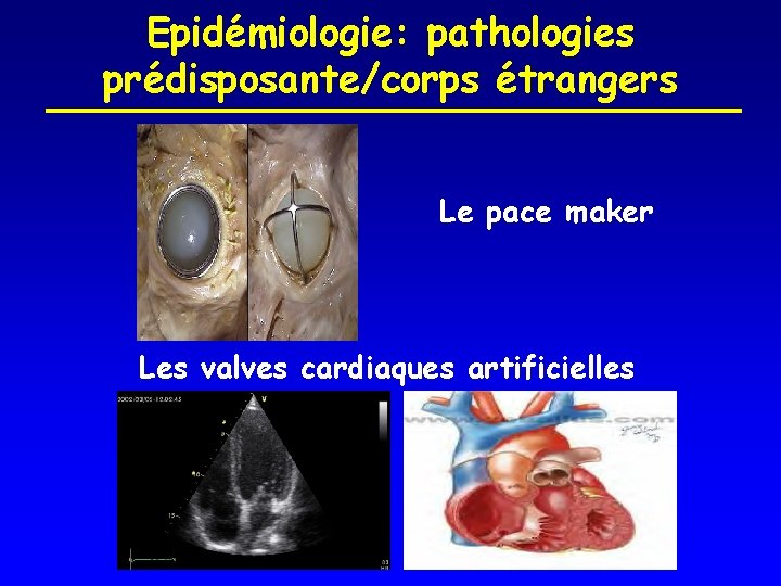 Epidémiologie: pathologies prédisposante/corps étrangers Le pace maker Les valves cardiaques artificielles 