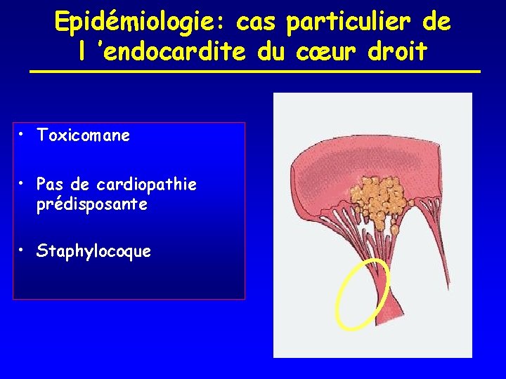 Epidémiologie: cas particulier de l ’endocardite du cœur droit • Toxicomane • Pas de