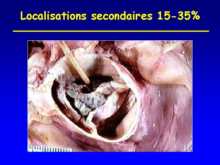 Localisations secondaires 15 -35% 