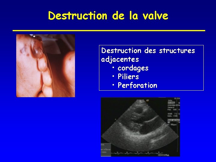 Destruction de la valve Destruction des structures adjacentes • cordages • Piliers • Perforation