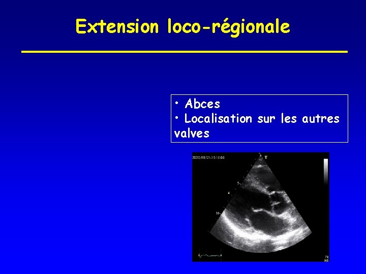 Extension loco-régionale • Abces • Localisation sur les autres valves 