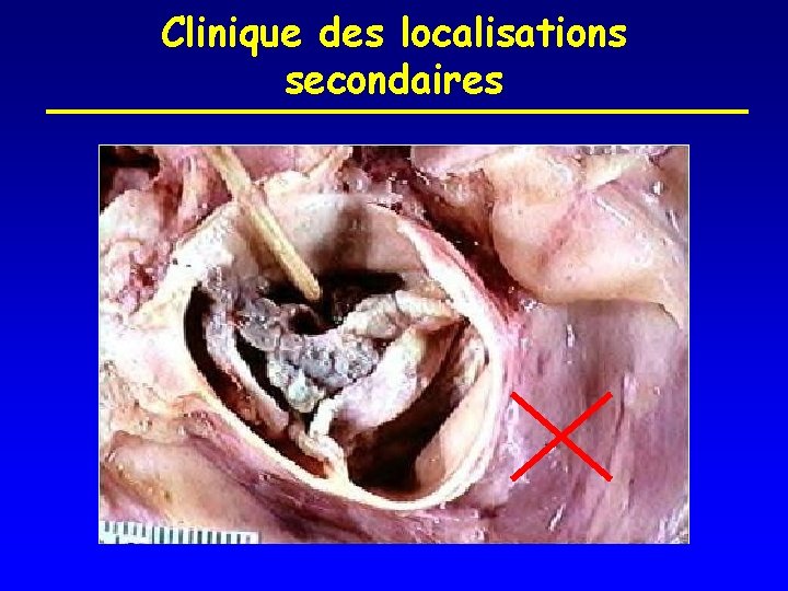 Clinique des localisations secondaires 