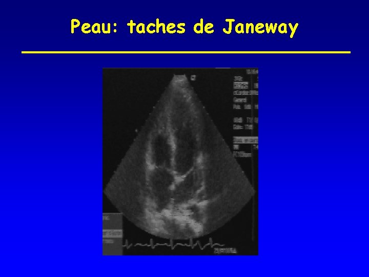 Peau: taches de Janeway 