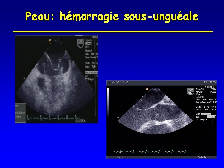 Peau: hémorragie sous-unguéale 