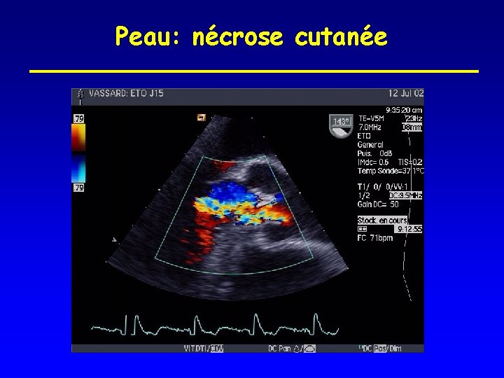 Peau: nécrose cutanée 