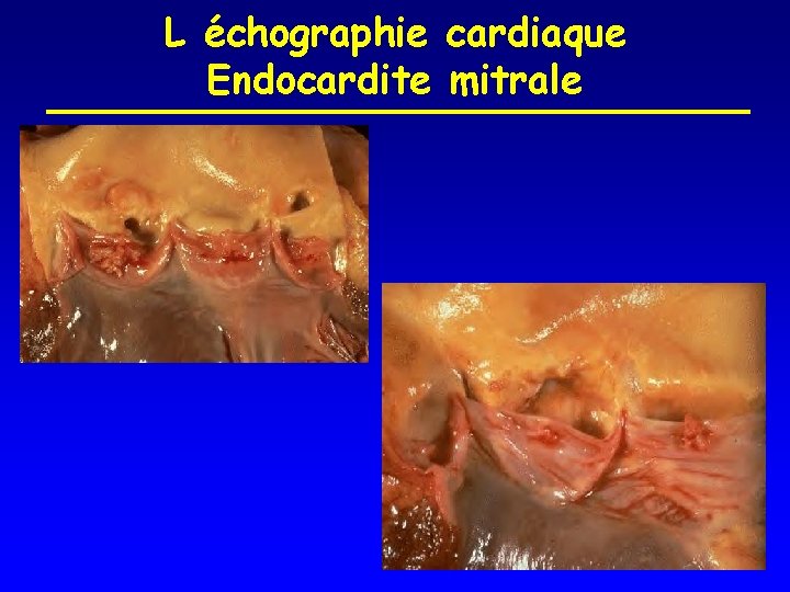 L échographie cardiaque Endocardite mitrale 