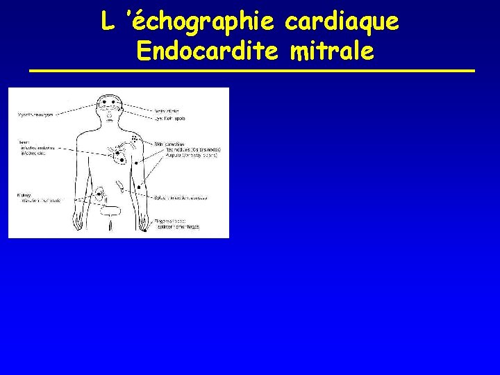 L ’échographie cardiaque Endocardite mitrale 