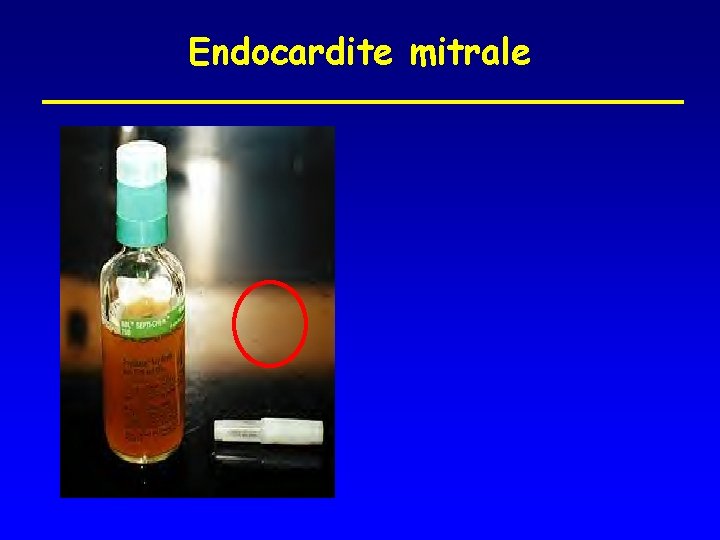 Endocardite mitrale 