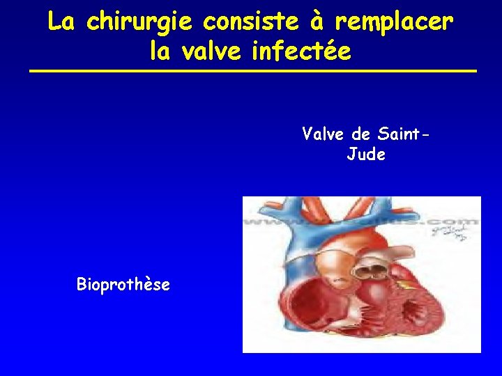 La chirurgie consiste à remplacer la valve infectée Valve de Saint. Jude Bioprothèse 