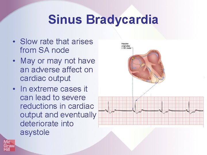 Sinus Bradycardia • Slow rate that arises from SA node • May or may