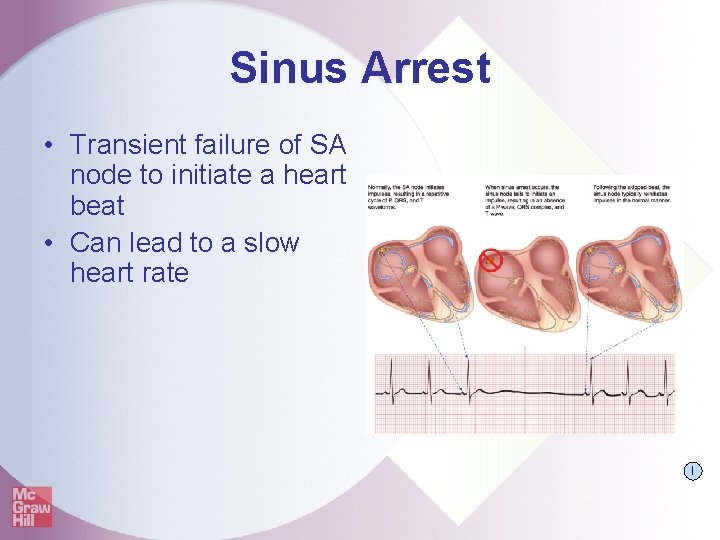 Sinus Arrest • Transient failure of SA node to initiate a heart beat •