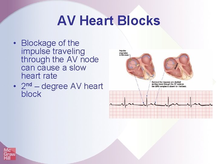 AV Heart Blocks • Blockage of the impulse traveling through the AV node can