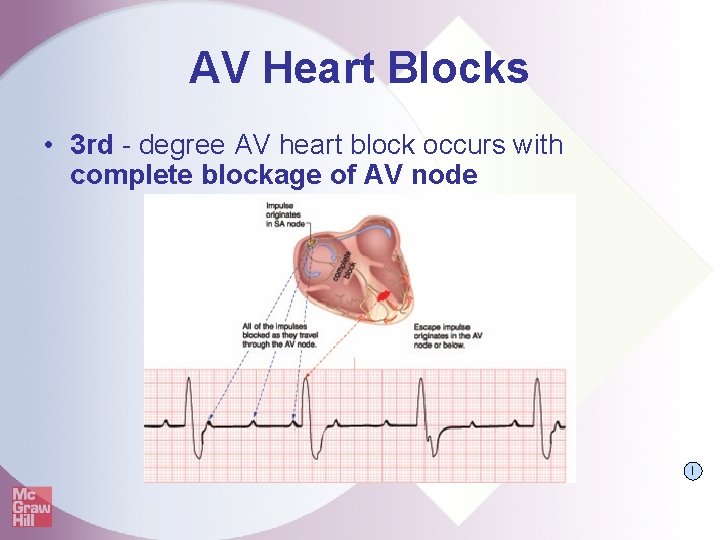AV Heart Blocks • 3 rd - degree AV heart block occurs with complete