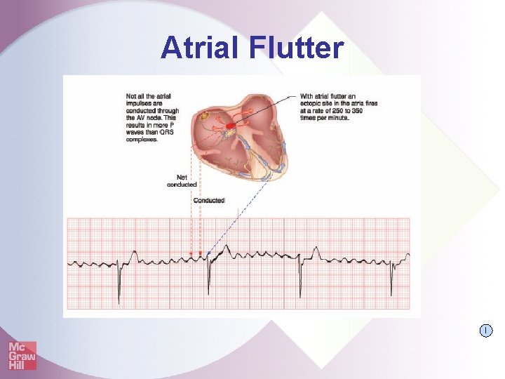 Atrial Flutter I 