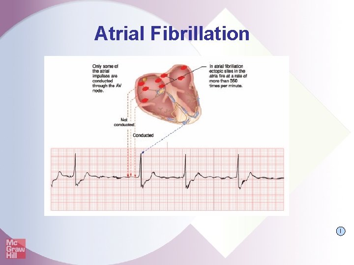 Atrial Fibrillation I 
