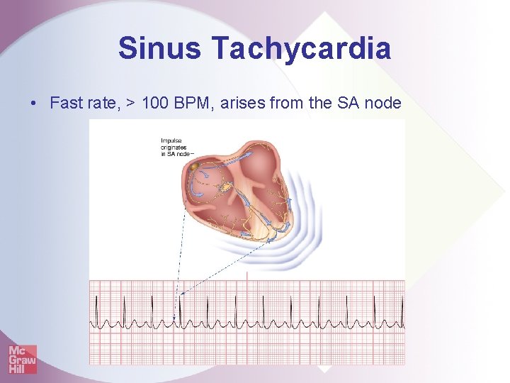 Sinus Tachycardia • Fast rate, > 100 BPM, arises from the SA node 