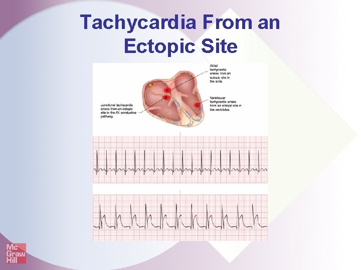 Tachycardia From an Ectopic Site 