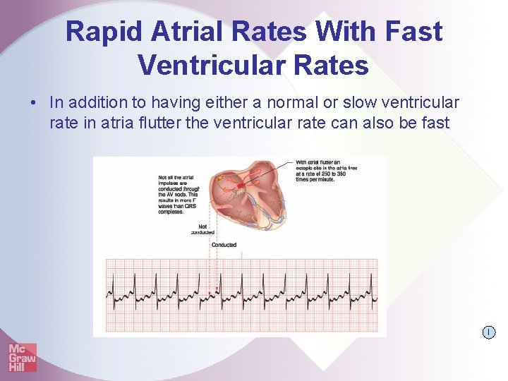 Rapid Atrial Rates With Fast Ventricular Rates • In addition to having either a