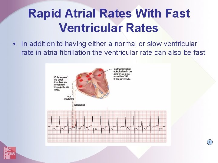 Rapid Atrial Rates With Fast Ventricular Rates • In addition to having either a