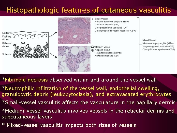 Histopathologic features of cutaneous vasculitis *Fibrinoid necrosis observed within and around the vessel wall