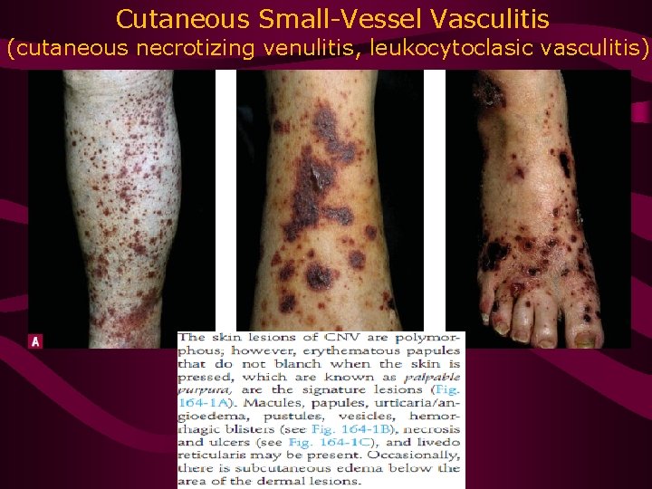 Cutaneous Small-Vessel Vasculitis (cutaneous necrotizing venulitis, leukocytoclasic vasculitis) 