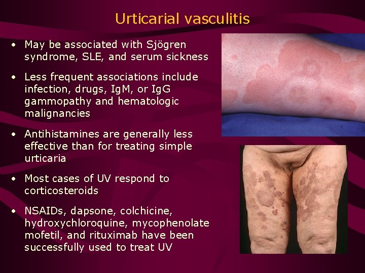 Urticarial vasculitis • May be associated with Sjögren syndrome, SLE, and serum sickness •