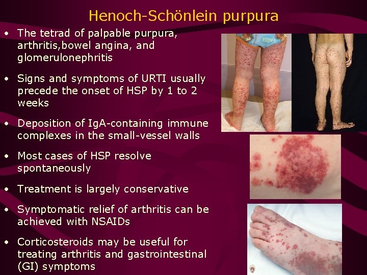 Henoch-Schönlein purpura • The tetrad of palpable purpura, arthritis, bowel angina, and glomerulonephritis •
