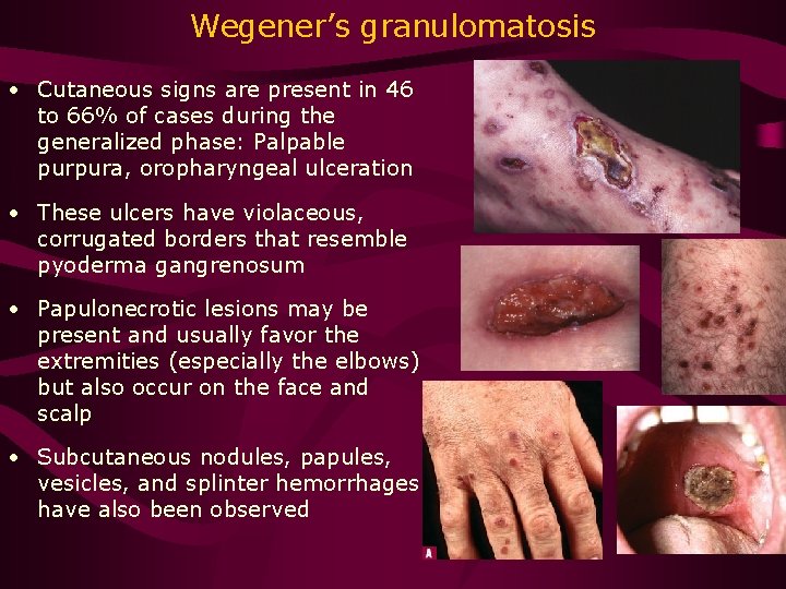 Wegener’s granulomatosis • Cutaneous signs are present in 46 to 66% of cases during