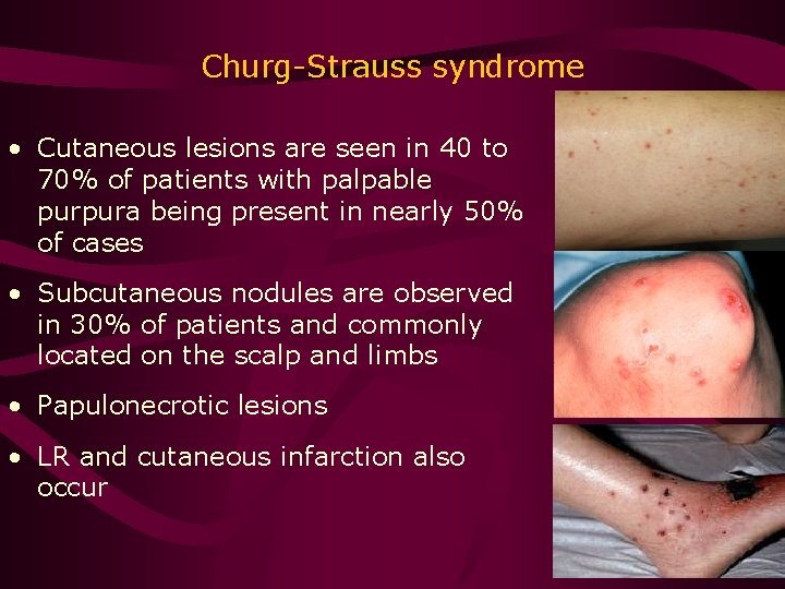 Churg-Strauss syndrome • Cutaneous lesions are seen in 40 to 70% of patients with