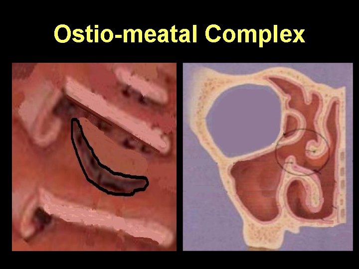 Ostio-meatal Complex 