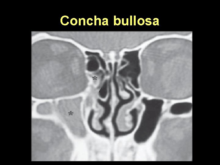 Concha bullosa 