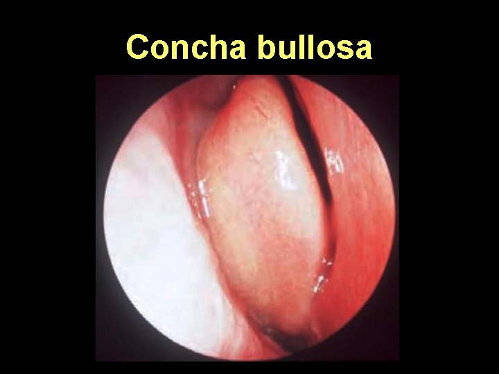 Concha bullosa 