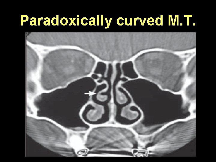 Paradoxically curved M. T. 
