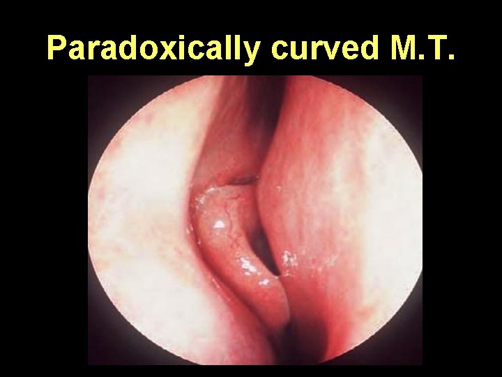 Paradoxically curved M. T. 