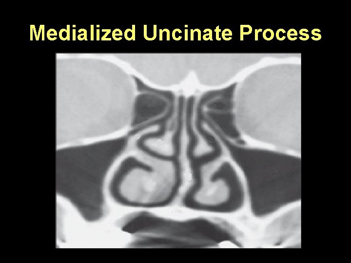Medialized Uncinate Process 
