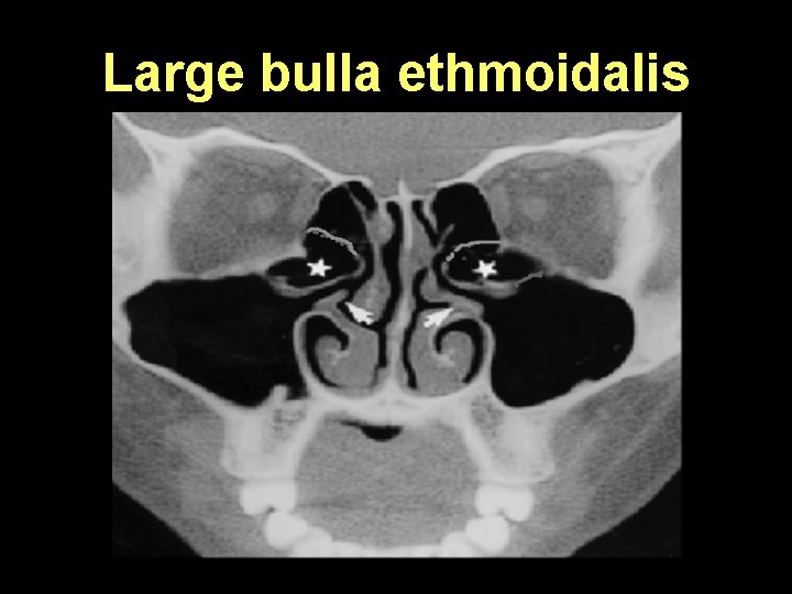 Large bulla ethmoidalis 
