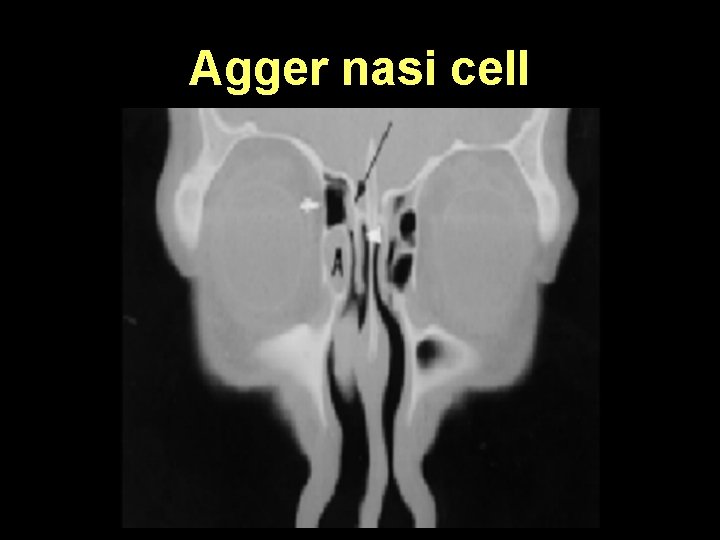 Agger nasi cell 
