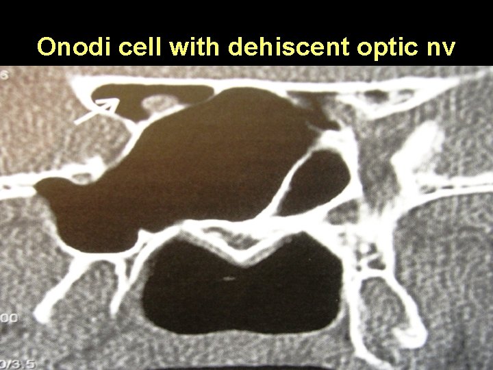Onodi cell with dehiscent optic nv 