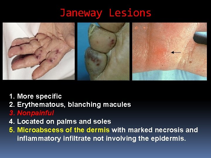 Janeway Lesions 1. More specific 2. Erythematous, blanching macules 3. Nonpainful 4. Located on Janeway Lesions 1. More specific 2. Erythematous, blanching macules 3. Nonpainful 4. Located on