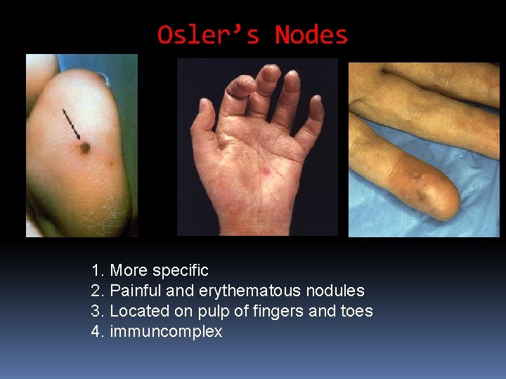 Osler’s Nodes 1. More specific 2. Painful and erythematous nodules 3. Located on pulp Osler’s Nodes 1. More specific 2. Painful and erythematous nodules 3. Located on pulp