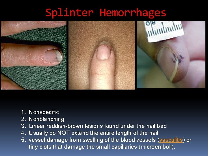 Splinter Hemorrhages 1. 2. 3. 4. 5. Nonspecific Nonblanching Linear reddish-brown lesions found under Splinter Hemorrhages 1. 2. 3. 4. 5. Nonspecific Nonblanching Linear reddish-brown lesions found under