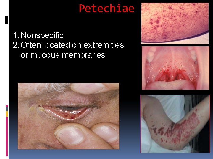 Petechiae 1. Nonspecific 2. Often located on extremities or mucous membranes Petechiae 1. Nonspecific 2. Often located on extremities or mucous membranes