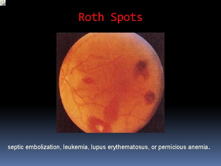 Roth Spots septic embolization, leukemia, lupus erythematosus, or pernicious anemia. Roth Spots septic embolization, leukemia, lupus erythematosus, or pernicious anemia.