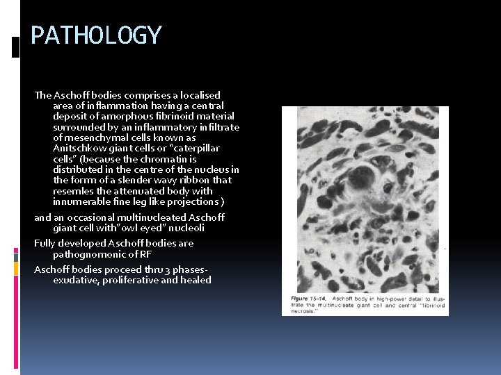 PATHOLOGY The Aschoff bodies comprises a localised area of inflammation having a central deposit PATHOLOGY The Aschoff bodies comprises a localised area of inflammation having a central deposit
