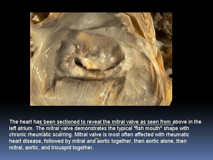 The heart has been sectioned to reveal the mitral valve as seen from above The heart has been sectioned to reveal the mitral valve as seen from above