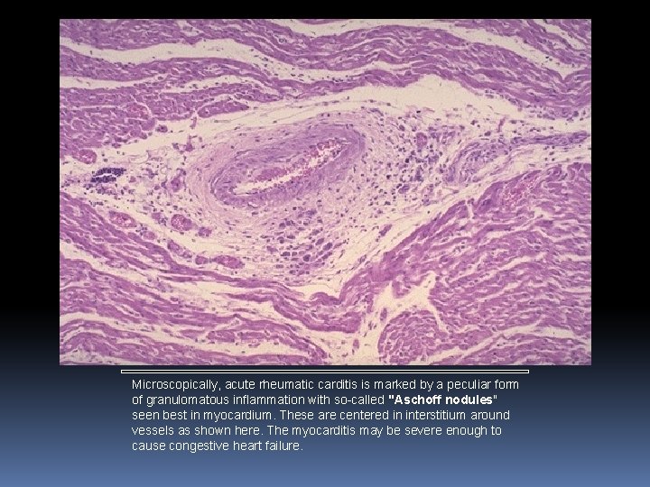 Microscopically, acute rheumatic carditis is marked by a peculiar form of granulomatous inflammation with Microscopically, acute rheumatic carditis is marked by a peculiar form of granulomatous inflammation with